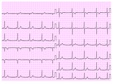 ECG-graph.png